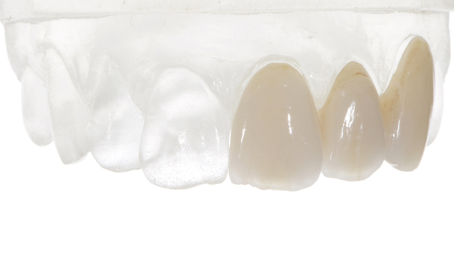 Faccette dentali 1