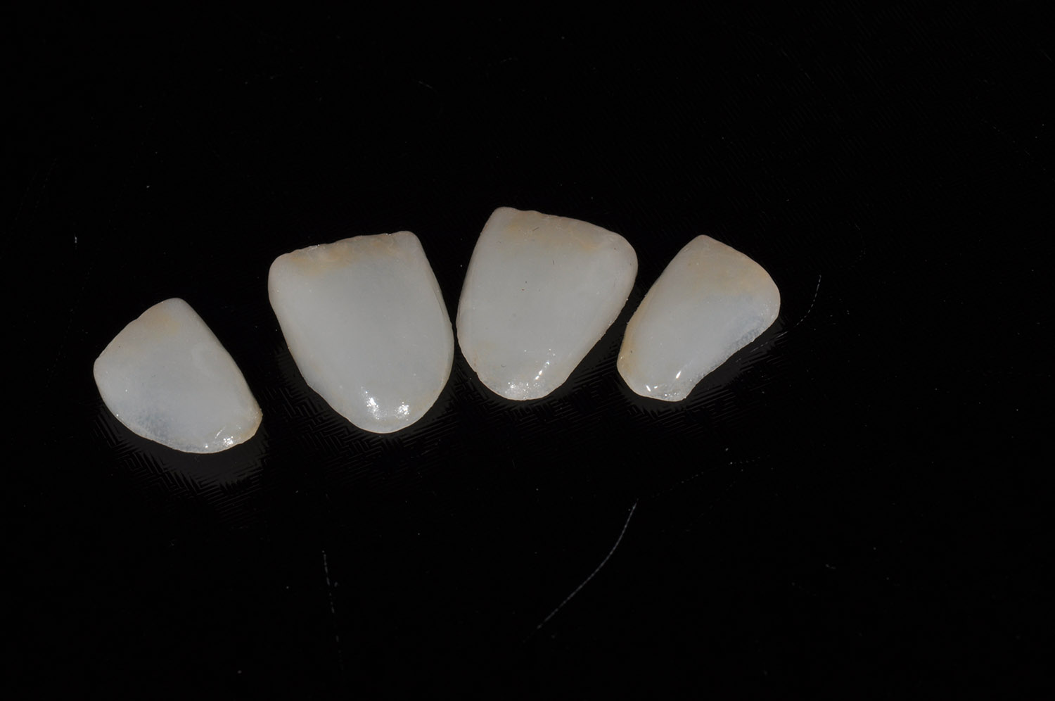 Faccette dentali 2
