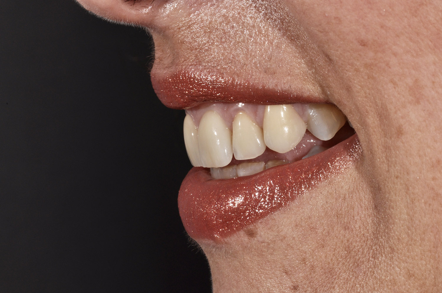 Faccette dentali 5