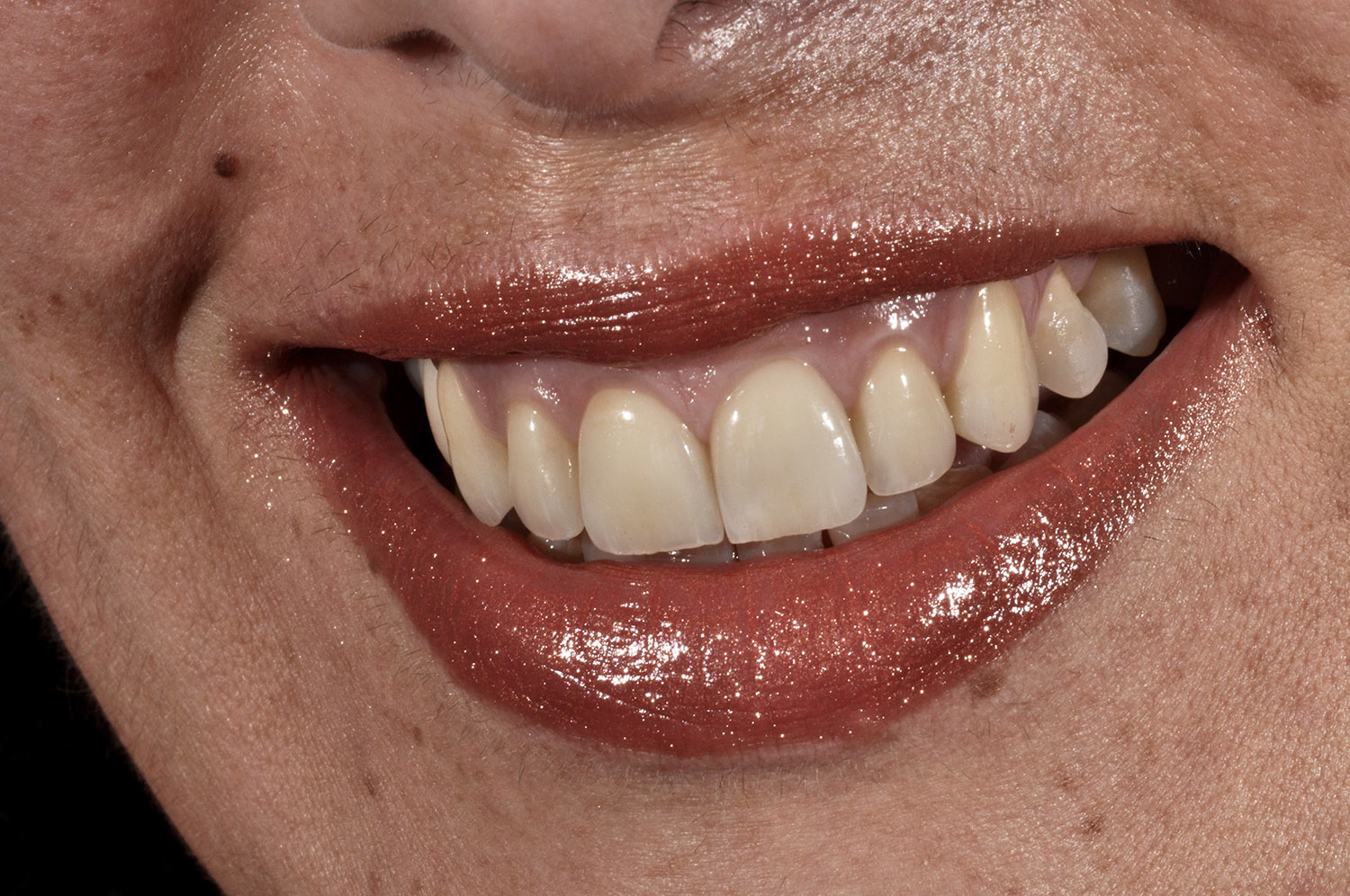Faccette dentali 6