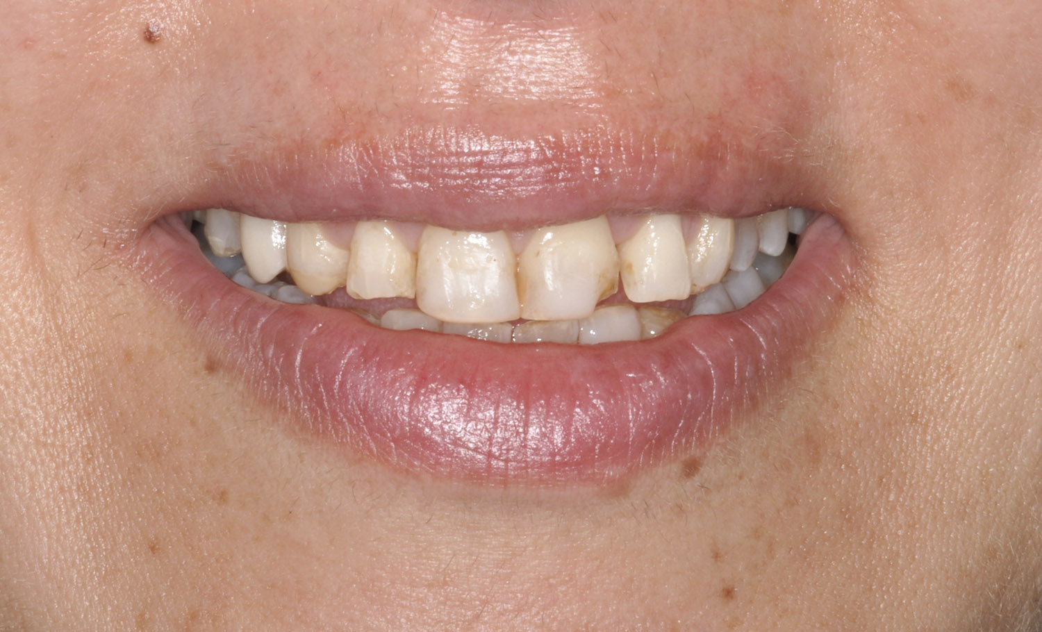 Faccette dentali 4
