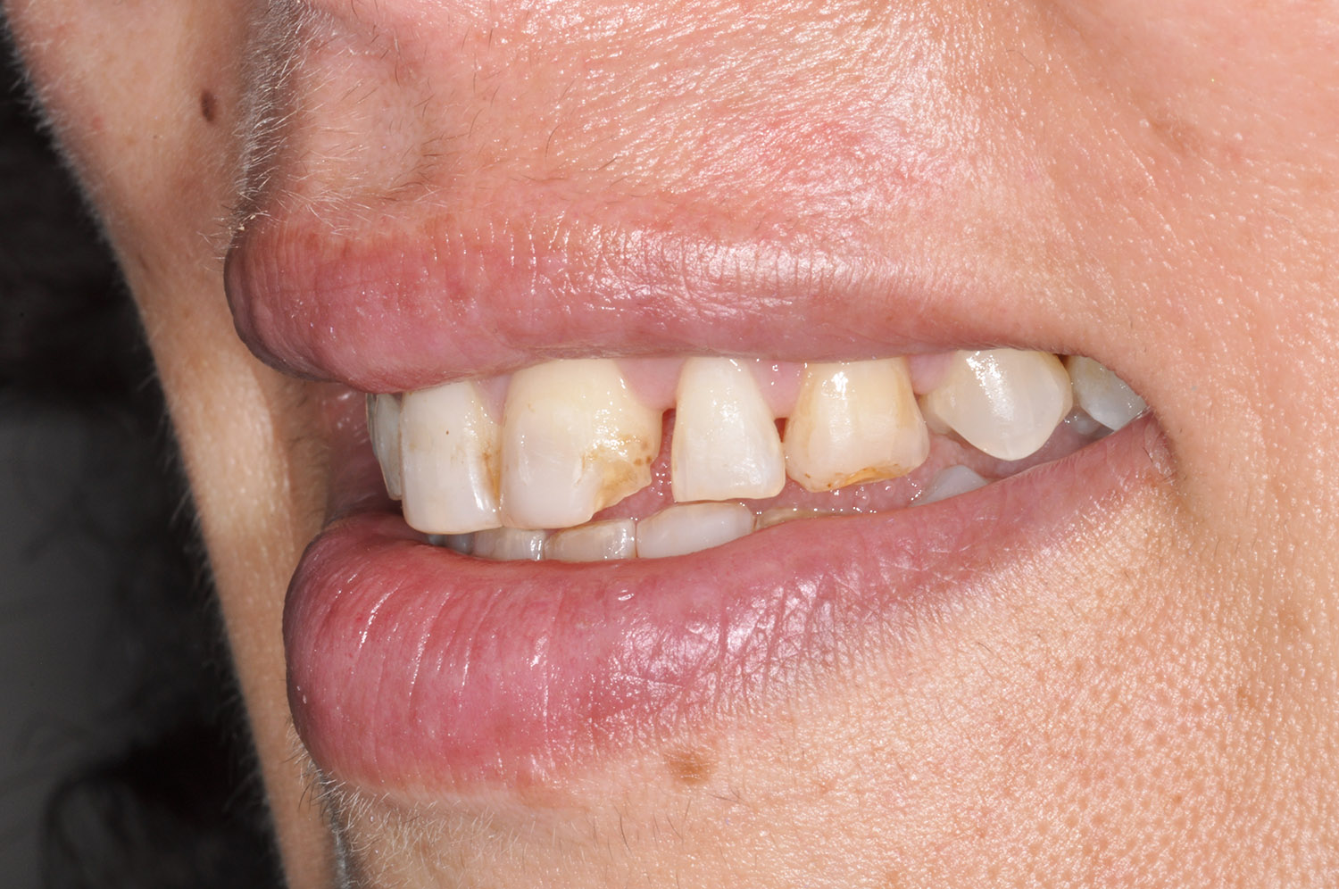 Faccette dentali 3